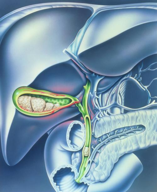 胆总管结石